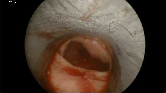 Cricopharyngeal bar
