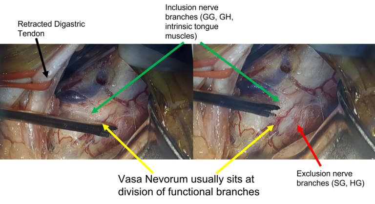Figure 2. Vasa nevorum landmark (yellow arrows) at functional branch division