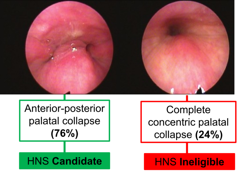 Figure 4. Complete concentric palatal collapse on DISE