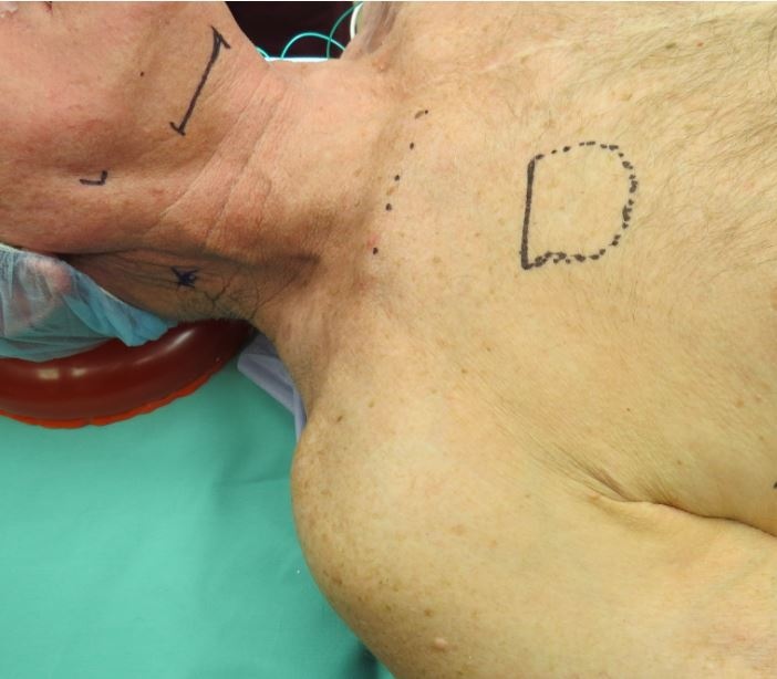 Figure 6. Incision placement (1) midway between hyoid bone and mandible (2) 3 cm inferior to clavicle