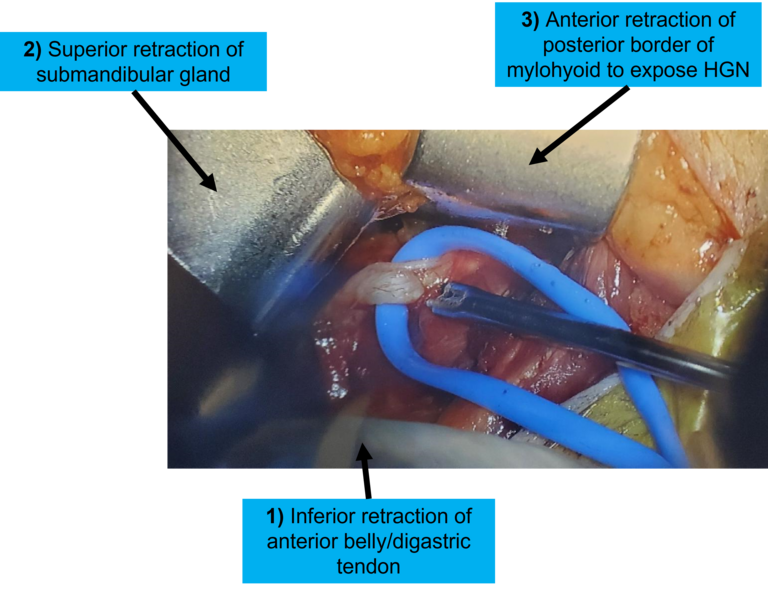 Figure 7. Neck incision anatomy and retraction