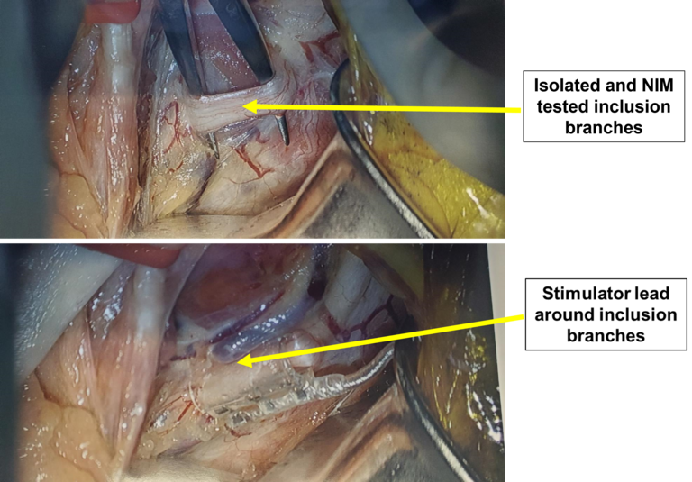 Figure 8. Stimulator cuff placement