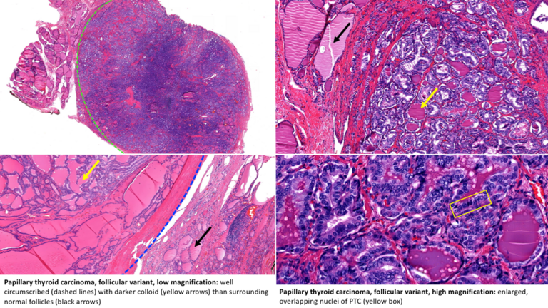 Papillary thyroid carcinoma, follicular variant, low magnification (upper left, upper right, lower left) and high magnification (lower right).