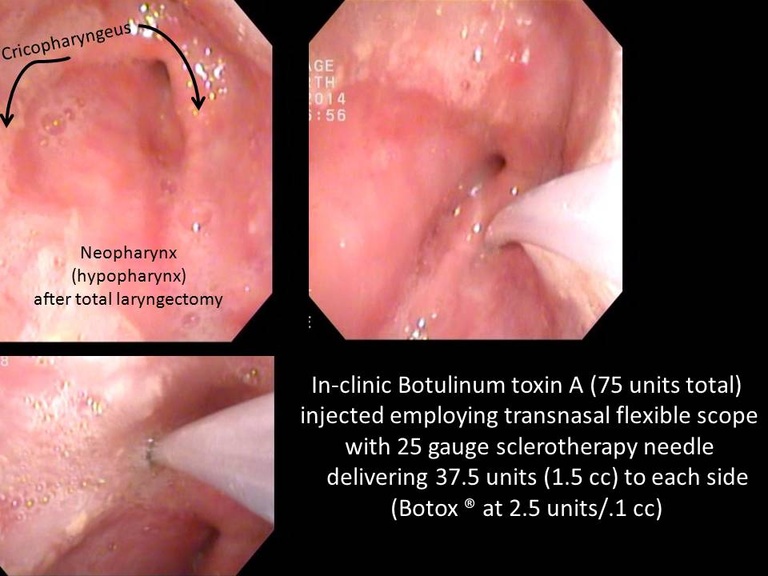 Injection%20of%20cp%20with%20botox.jpg