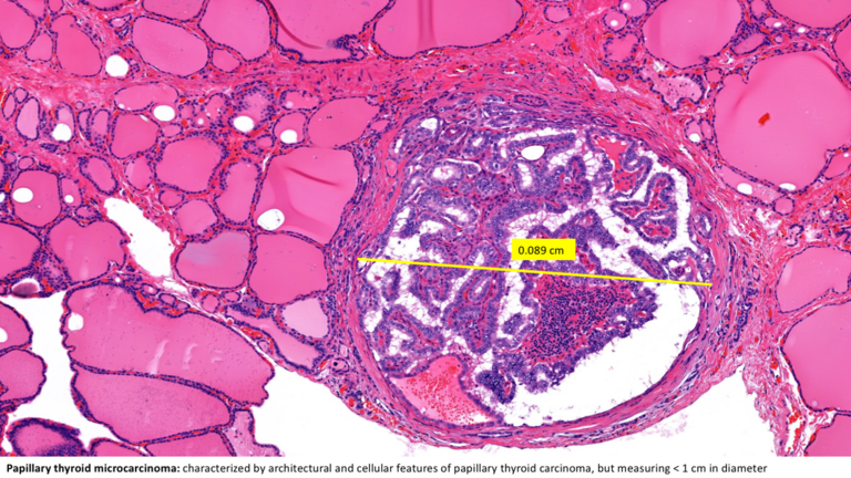 Papillary microcarcinoma, characterized by diameter measuring <1 cm