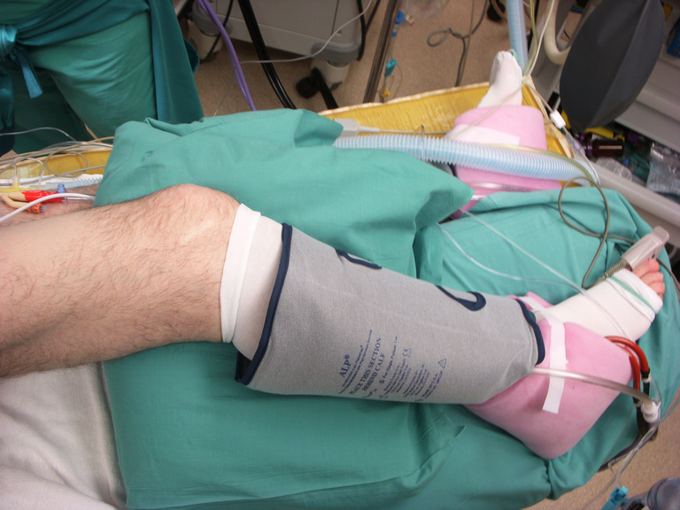 Knees must be properly padded as patient will be turned for flap harvesting.