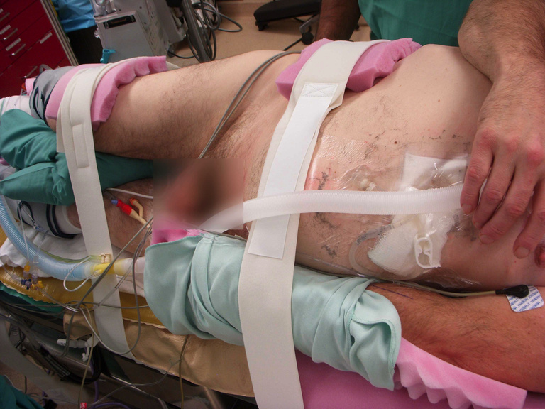  Patient must be secured to the table and contralateral side padded with care for position changes. This patient had a g-tube prior to surgery, which was excluded from the prep/drape.  