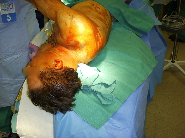    Note prior tracheotomy. Prep should go well into hairline. We also use clear plastic adhesive dressings over the eyes 