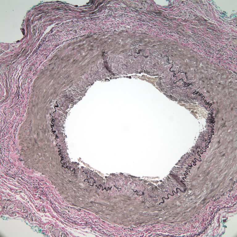 50x     Elastic lamina fragmentation    