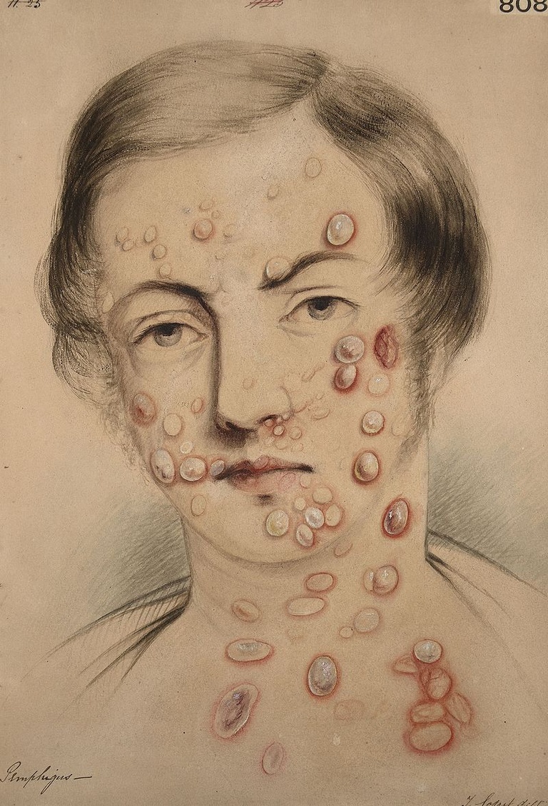 Watercolour drawing of the face and neck of a man affected with pemphigus. Medical Photographic Library Keywords: Godart, Thomas