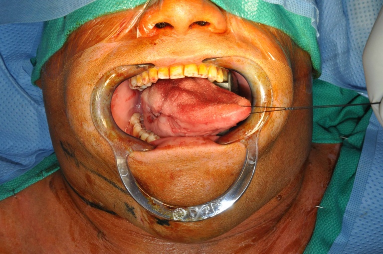 T2 tongue cancer with extensive submucosal extension 