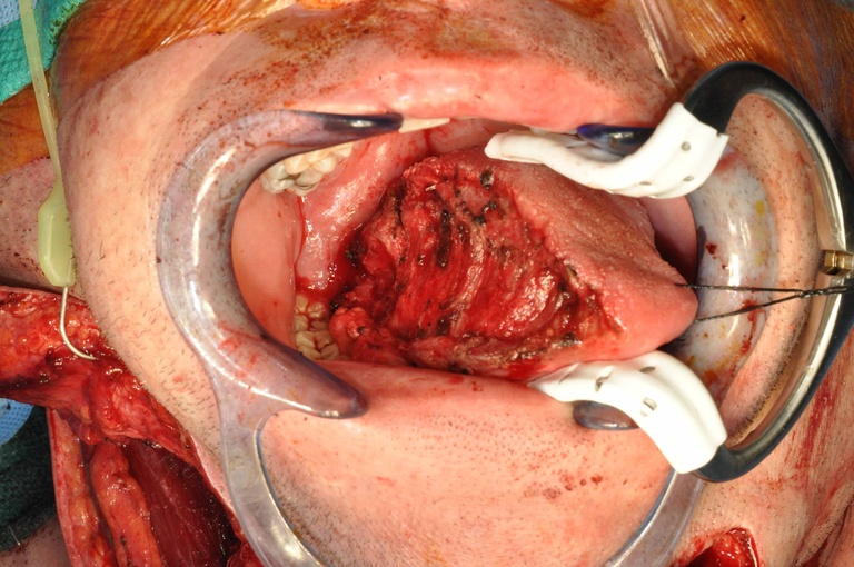 Hemiglossectomy defect