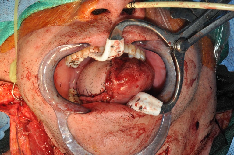 Flap after inset.  Flap was tunneled behind the mylohyoid muscle into oral cavity.