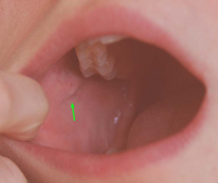 Right Parotid Papilla (Created by and used with permission from Hellerhoff)