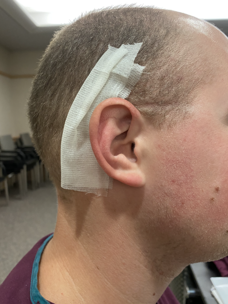Mastoid Dressing Apply