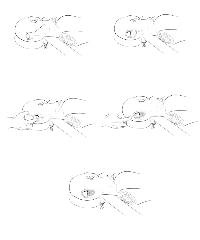 Shunt Scissors Sequence.jpg