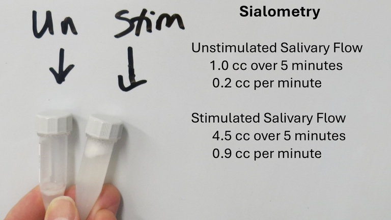 sialometry drip method