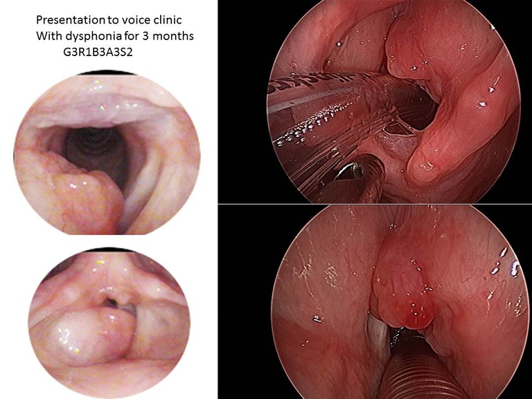 Findings on laryngoscopy