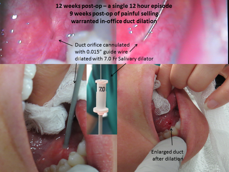 Patent duct at 12 weeks post op enlarged further with dilation in clinic