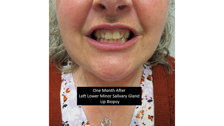 lip biopsy 10