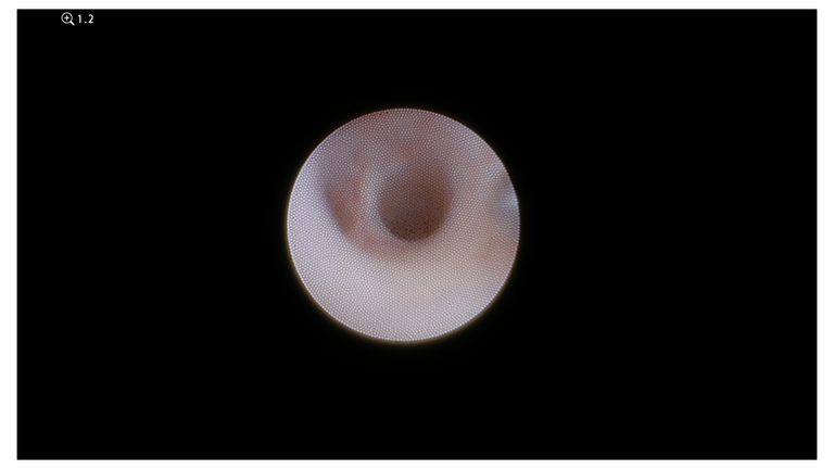 laser sialendoscopy for parotid stone