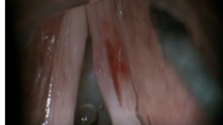 Resection vocal cord lesion with suture orientation