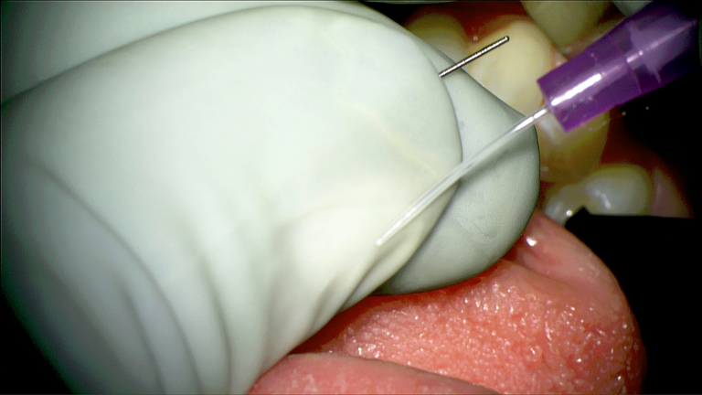 SMG cannulation with Prolene and 26 gauge angio