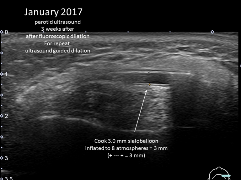 January 2017 in clinic ultrasound guided balloon dilation to 3 mm