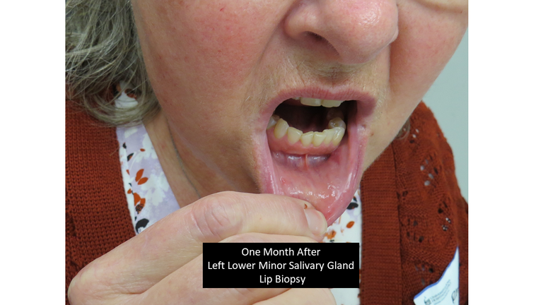 lip biopsy 11