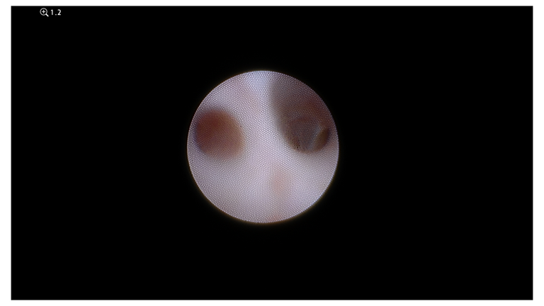 laser sialendoscopy for parotid stone