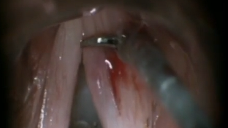 Resection vocal cord lesion with suture orientation