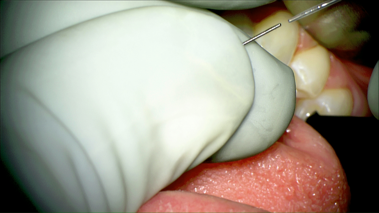 SMG cannulation with Prolene and 26 gauge angio
