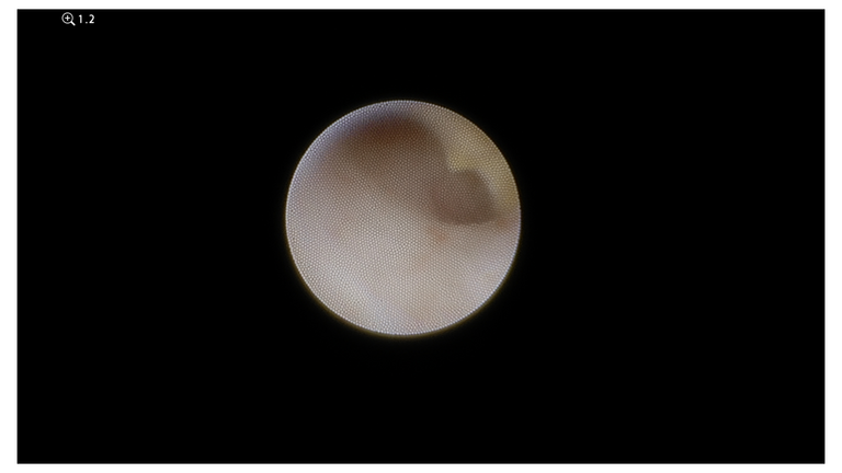 laser sialendoscopy for parotid stone