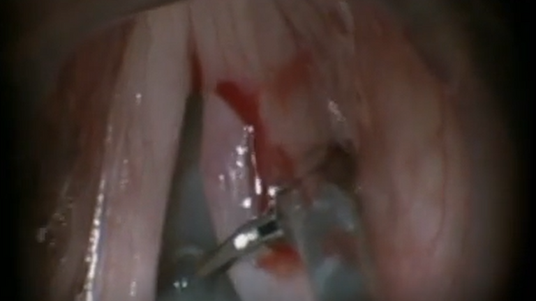 Resection vocal cord lesion with suture orientation