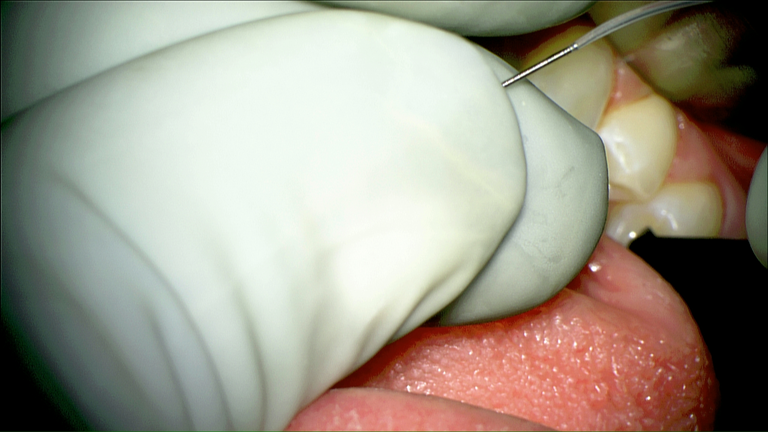 SMG cannulation with Prolene and 26 gauge angio