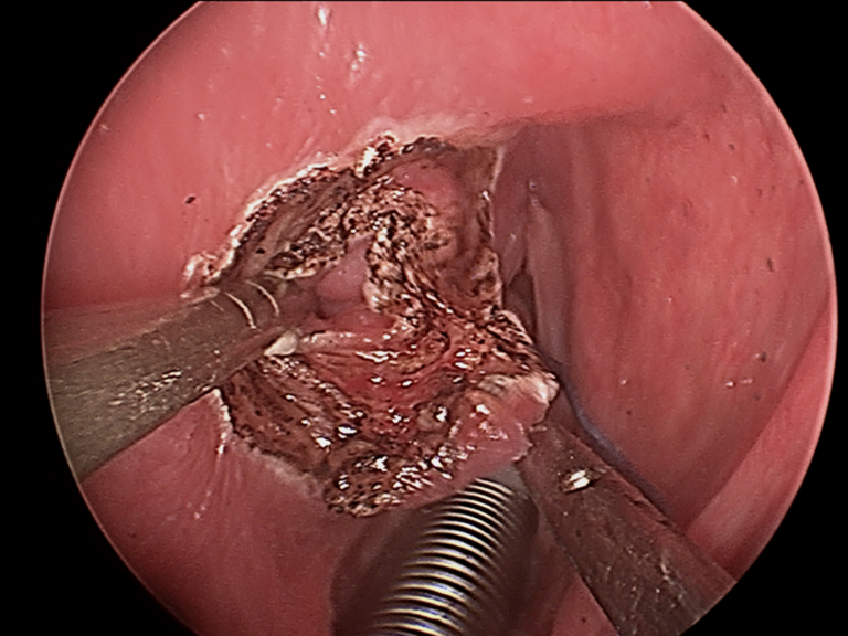 Intraop