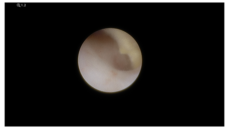 laser sialendoscopy for parotid stone