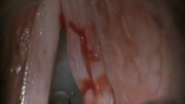 Resection vocal cord lesion with suture orientation
