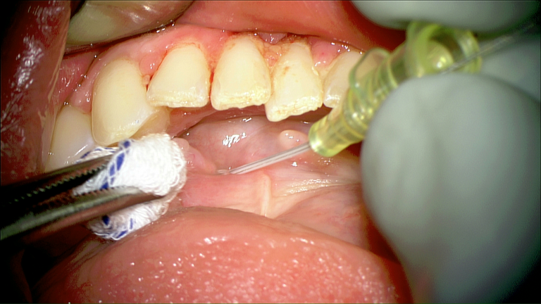 SMG cannulation with Prolene and 26 gauge angio