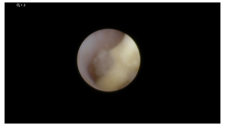 laser sialendoscopy for parotid stone