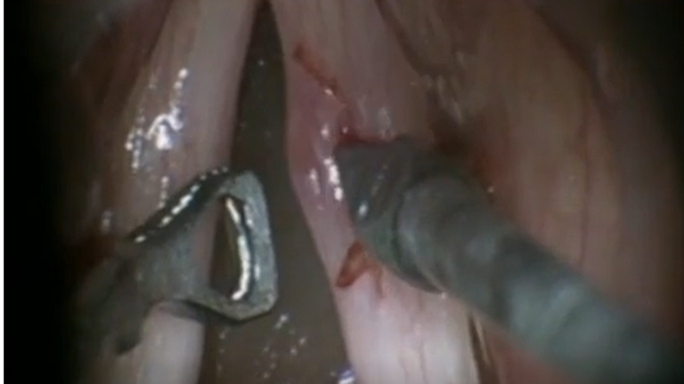 Resection vocal cord lesion with suture orientation