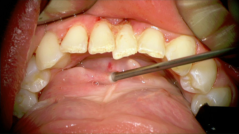 SMG cannulation with Prolene and 26 gauge angio