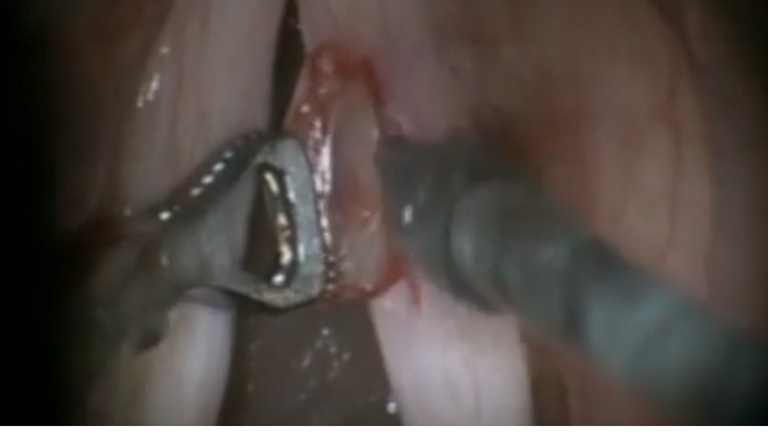 Resection vocal cord lesion with suture orientation