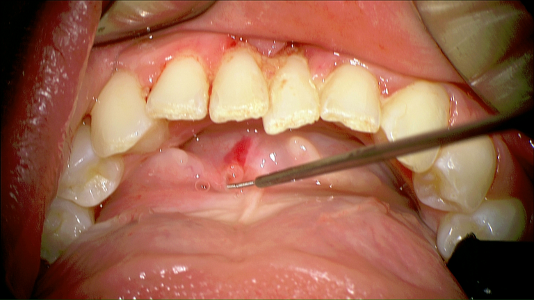 SMG cannulation with Prolene and 26 gauge angio