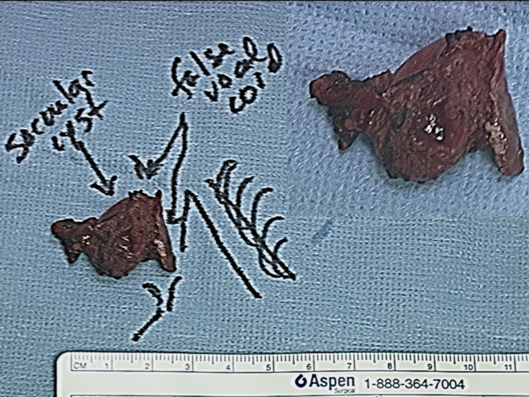 Intraop