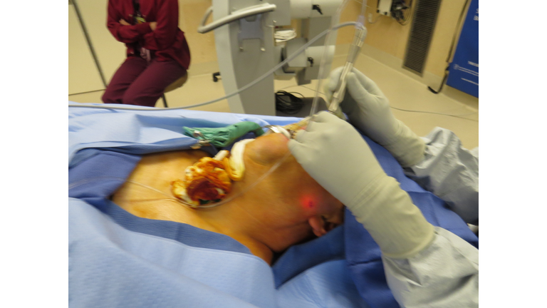 laser sialendoscopy for parotid stone