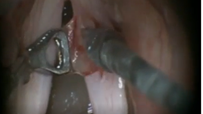 Resection vocal cord lesion with suture orientation