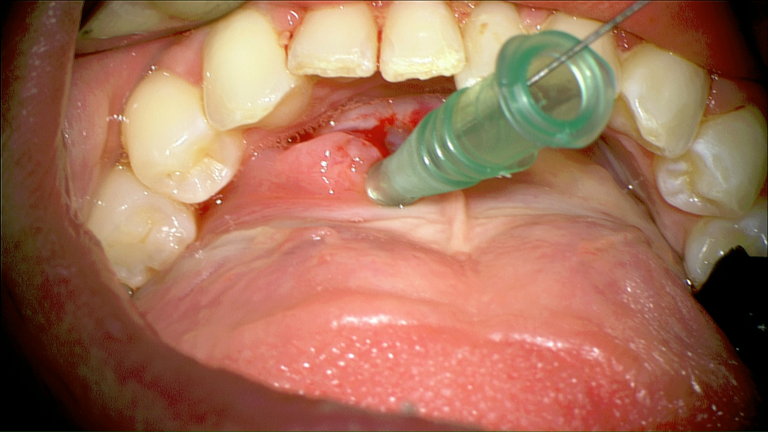 SMG cannulation with Prolene and 26 gauge angio