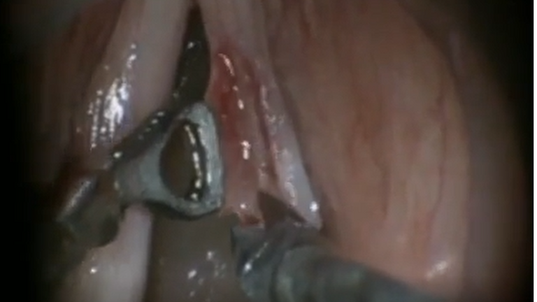 Resection vocal cord lesion with suture orientation