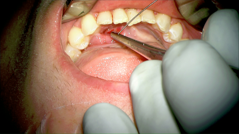 SMG cannulation with Prolene and 26 gauge angio